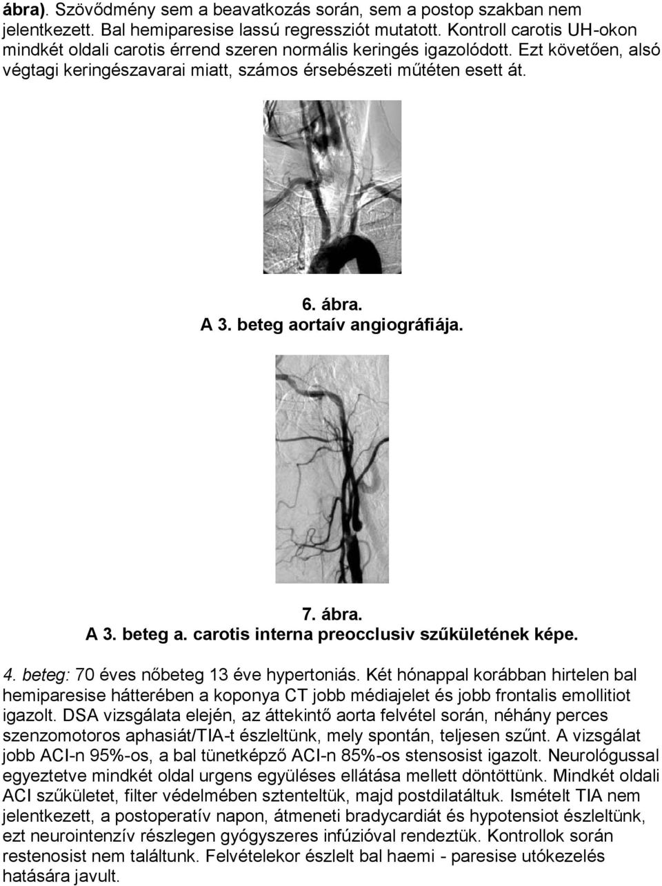 beteg aortaív angiográfiája. 7. ábra. A 3. beteg a. carotis interna preocclusiv szűkületének képe. 4. beteg: 70 éves nőbeteg 13 éve hypertoniás.