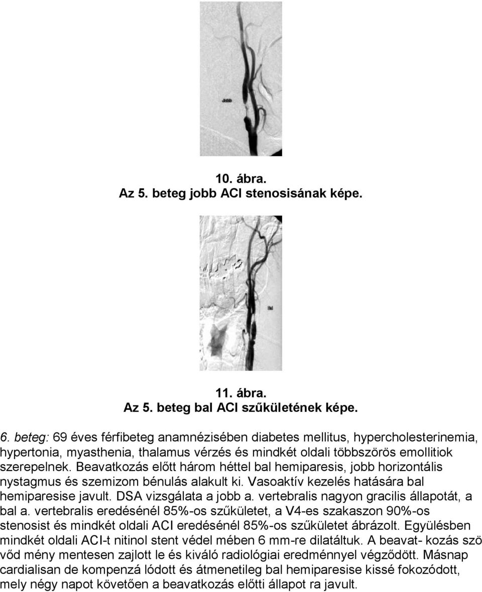 Beavatkozás előtt három héttel bal hemiparesis, jobb horizontális nystagmus és szemizom bénulás alakult ki. Vasoaktív kezelés hatására bal hemiparesise javult. DSA vizsgálata a jobb a.