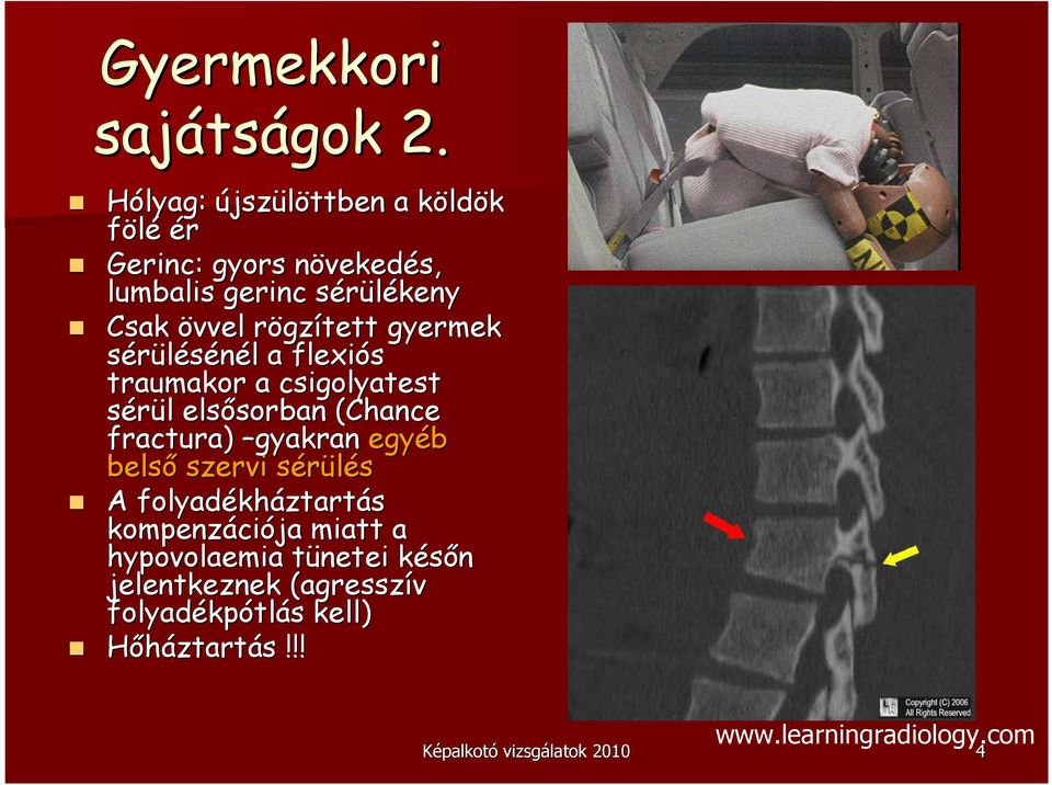 gzített gyermek sérülésénél l a flexiós traumakor a csigolyatest sérül l elsısorban sorban (Chance fractura) gyakran egyéb