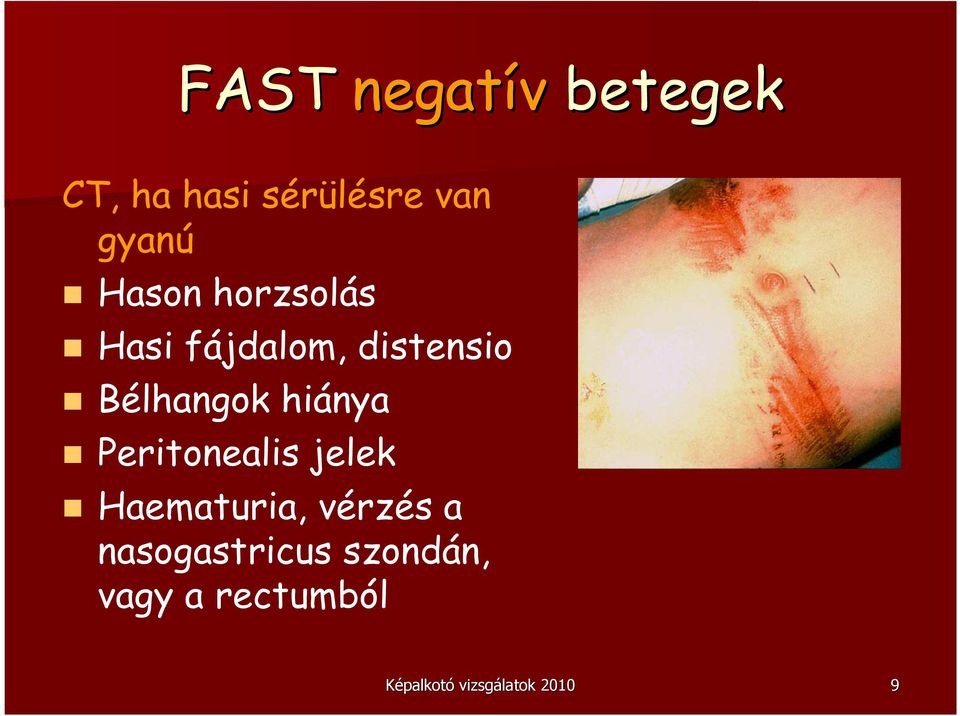 hiánya Peritonealis jelek Haematuria, vérzés a