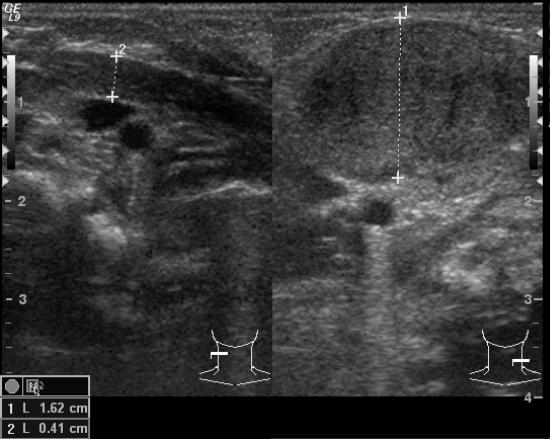 Fibromatosis colli 4-6 hetes korban Torticollis, tapintható nyaki terime Nehéz szülés M.