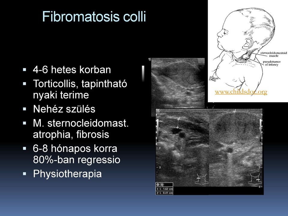 sternocleidomast.