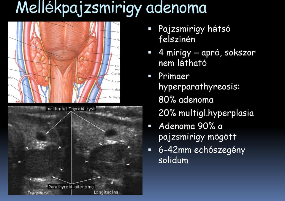 hyperparathyreosis: 80% adenoma 20% multigl.
