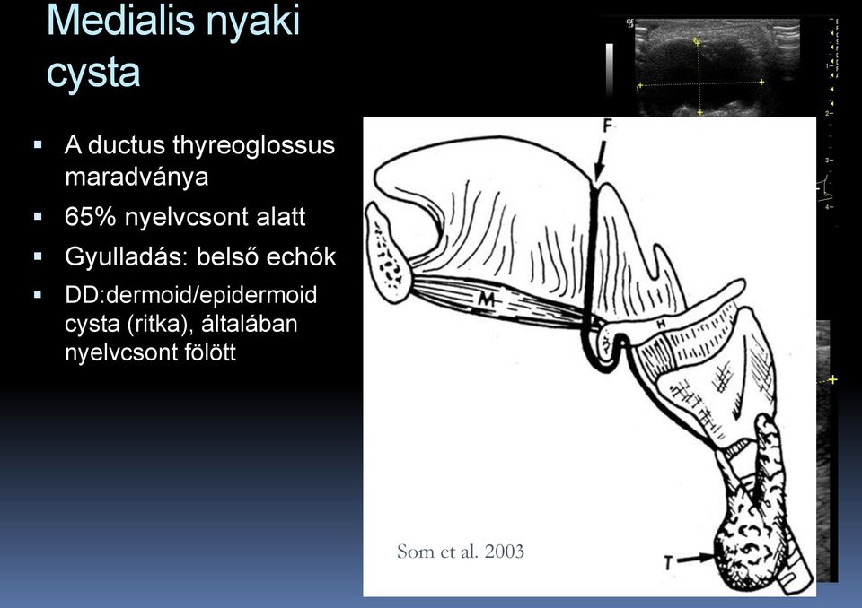 belső echók DD:dermoid/epidermoid cysta