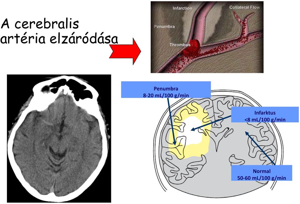 ml/100 g/min Infarktus <8