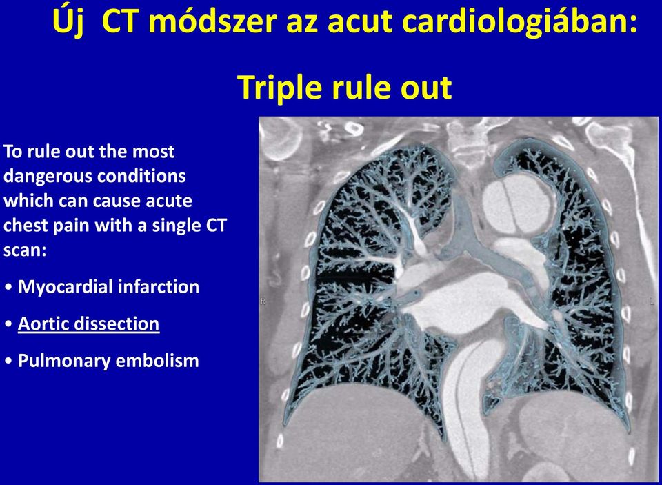 chest pain with a single CT scan: Myocardial