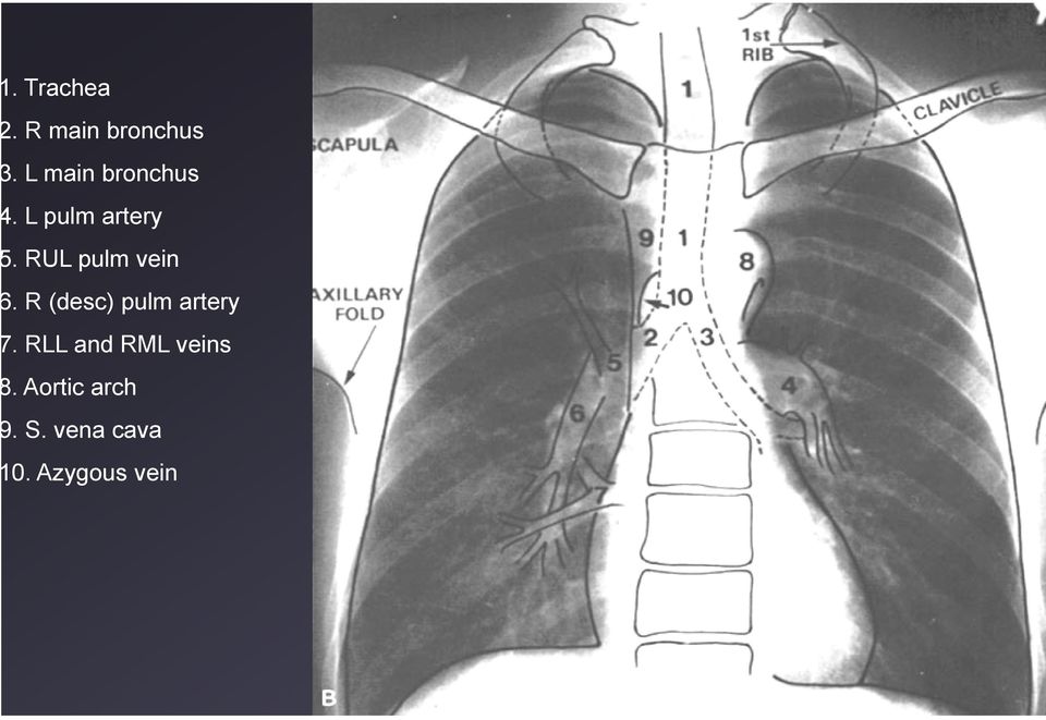 RUL pulm vein. R (desc) pulm artery.
