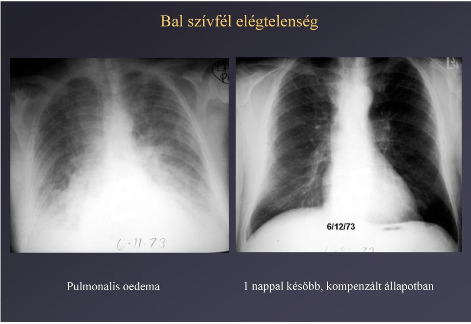 Pulmonalis oedema 1