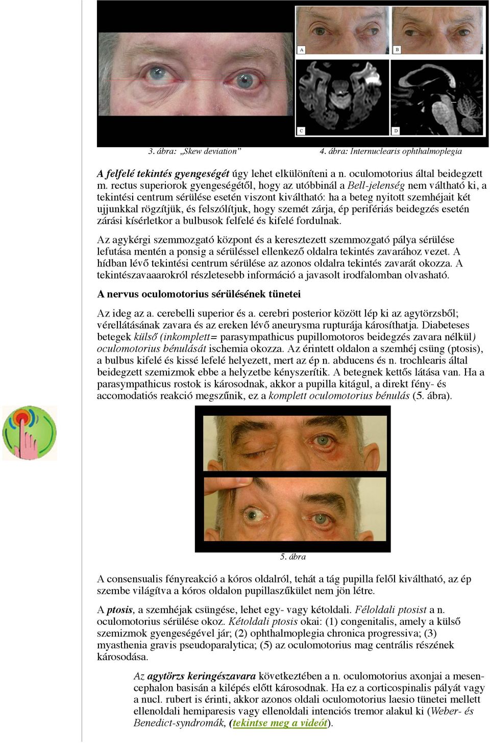 felszólítjuk, hogy szemét zárja, ép perifériás beidegzés esetén zárási kísérletkor a bulbusok felfelé és kifelé fordulnak.