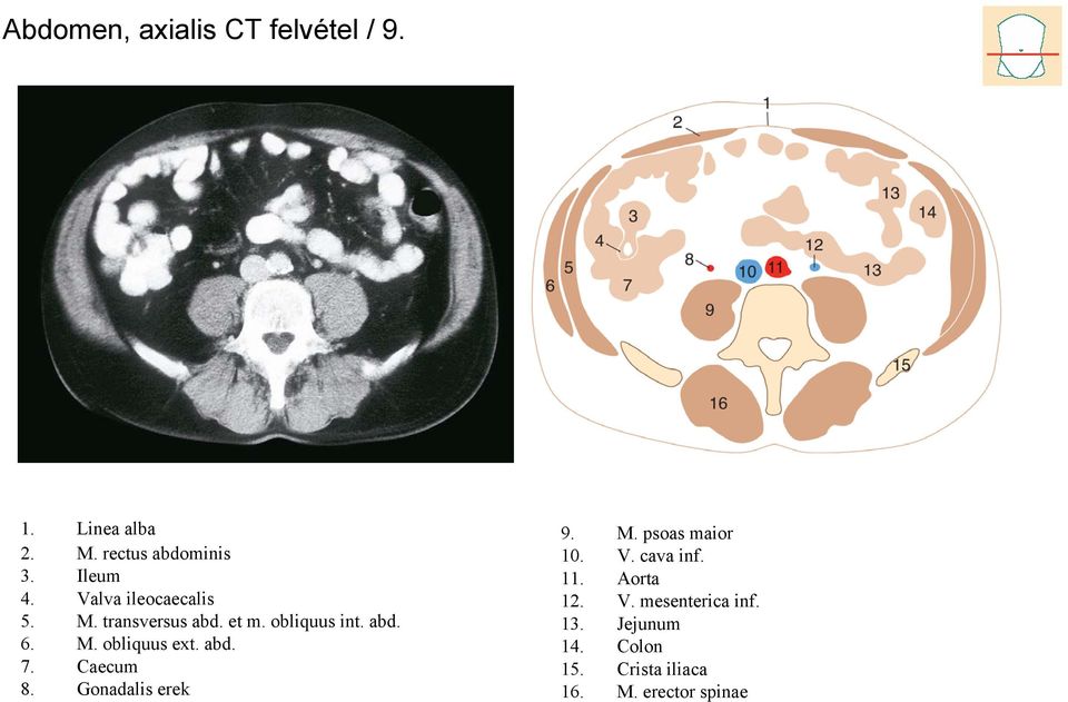 abd. 7. Caecum 8. Gonadalis erek 9. M. psoas maior 10. V. cava inf. 11. Aorta 12. V. mesenterica inf.