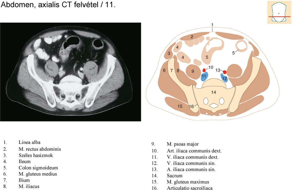 M. psoas major 10. Art. iliaca communis dext. 11. V. iliaca communis dext. 12. V. iliaca communis sin.