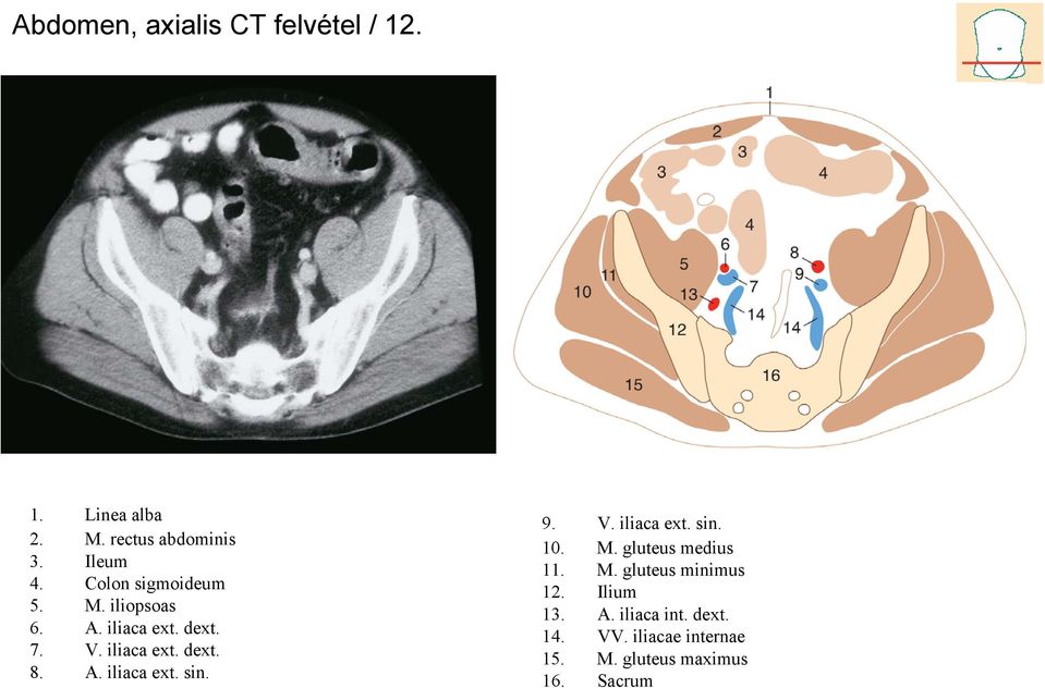 9. V. iliaca ext. sin. 10. M. gluteus medius 11. M. gluteus minimus 12. Ilium 13. A.