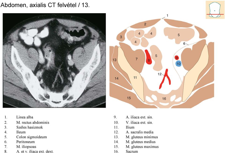 et v. iliaca ext. dext. 9. A. iliaca ext. sin. 10. V. iliaca ext. sin. 11. Ilium 12.