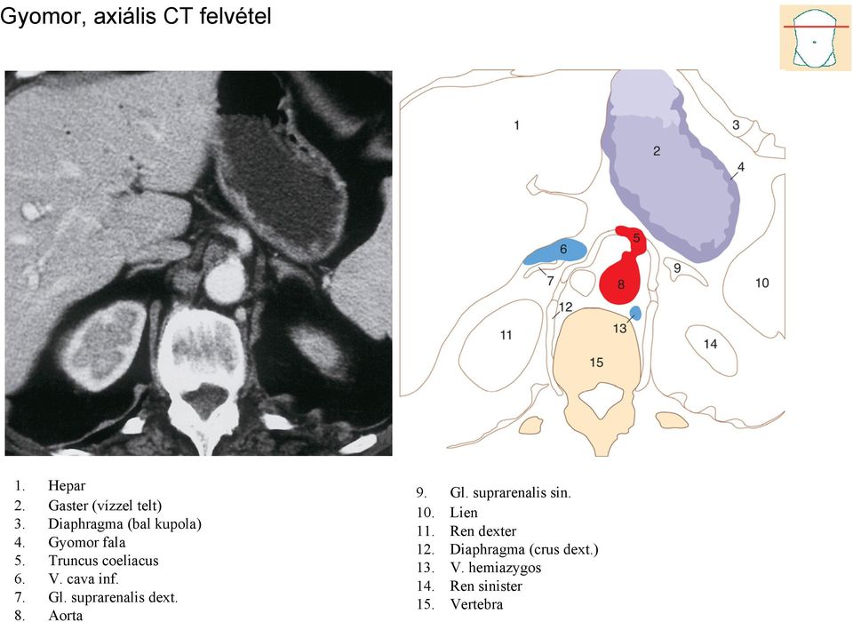 7. Gl. suprarenalis dext. 8. Aorta 9. Gl. suprarenalis sin. 10. Lien 11.