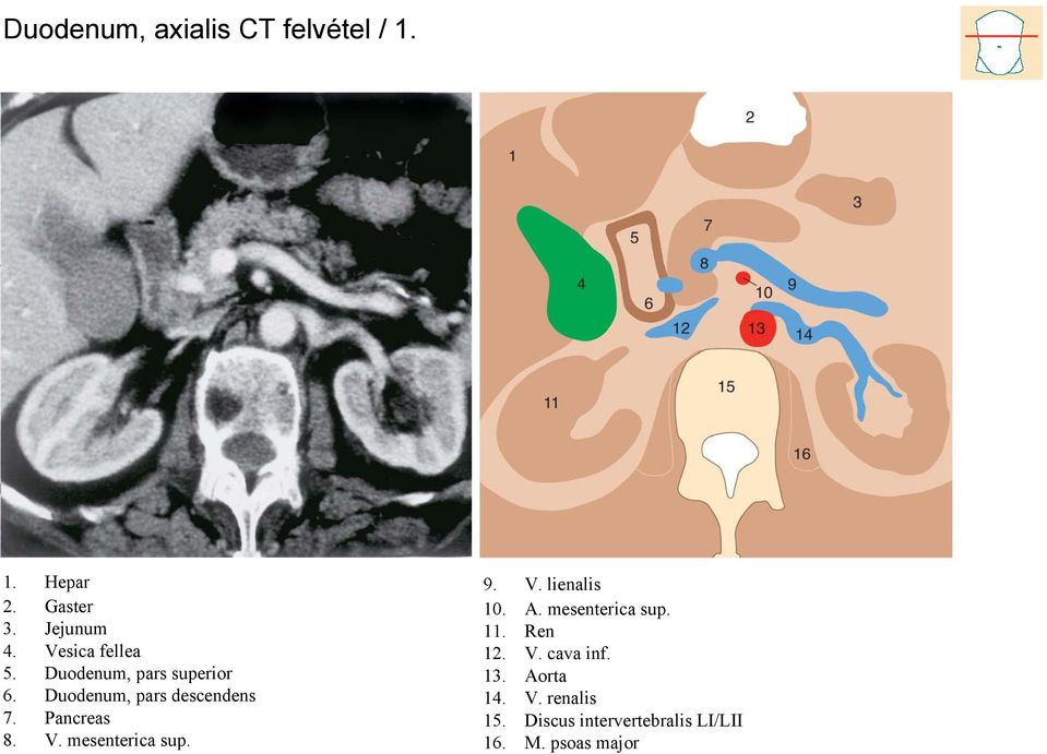 Pancreas 8. V. mesenterica sup. 9. V. lienalis 10. A. mesenterica sup. 11.