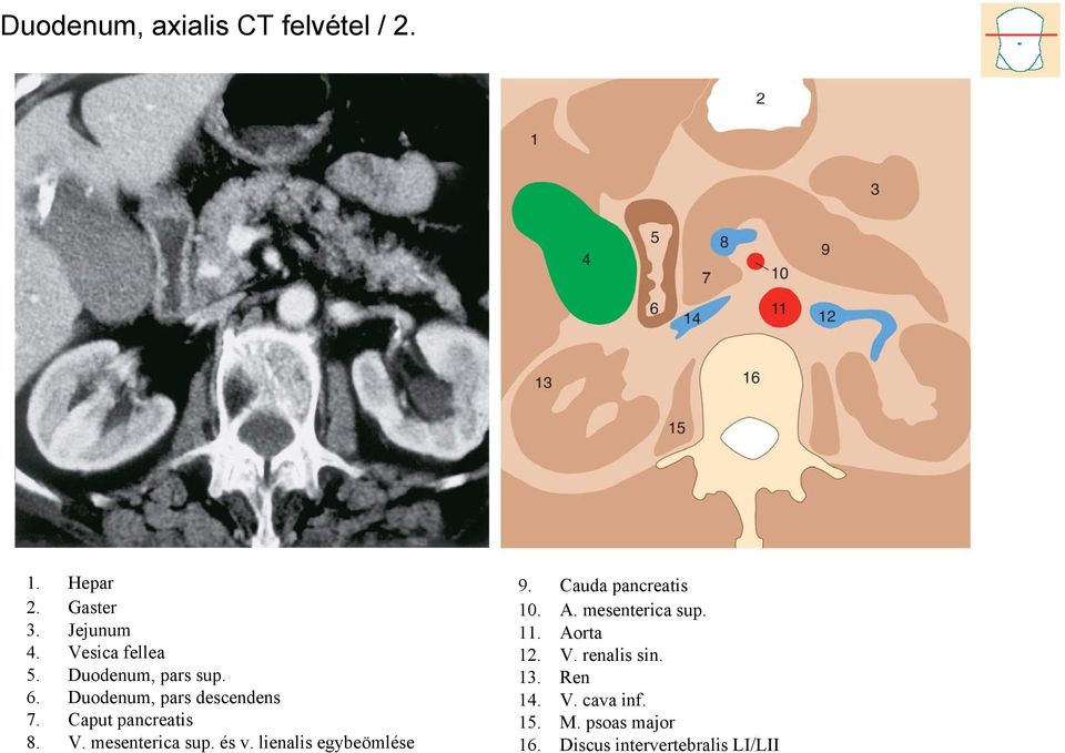 mesenterica sup. és v. lienalis egybeömlése 9. Cauda pancreatis 10. A. mesenterica sup.