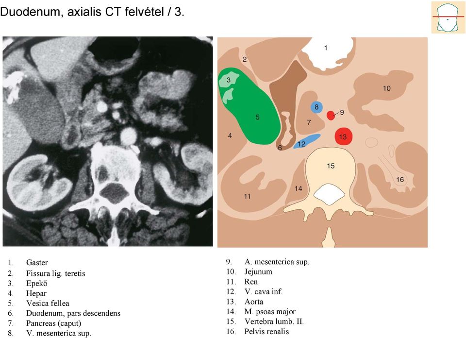 Pancreas (caput) 8. V. mesenterica sup. 9. A. mesenterica sup. 10.