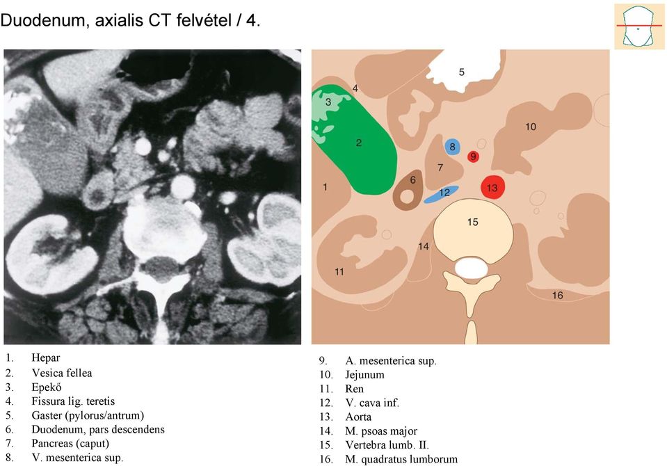 Pancreas (caput) 8. V. mesenterica sup. 9. A. mesenterica sup. 10. Jejunum 11.