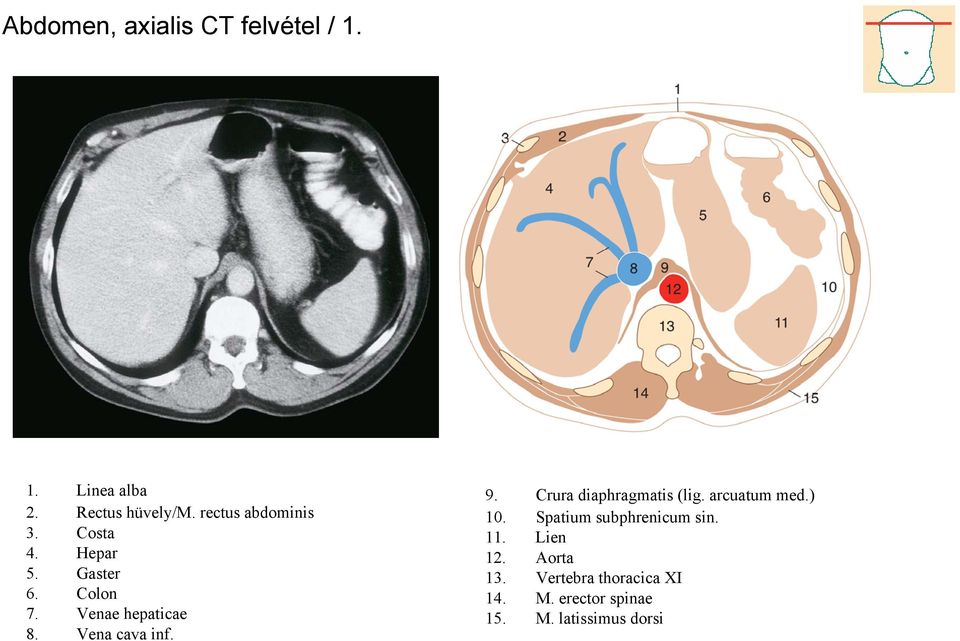 Vena cava inf. 9. Crura diaphragmatis (lig. arcuatum med.) 10.