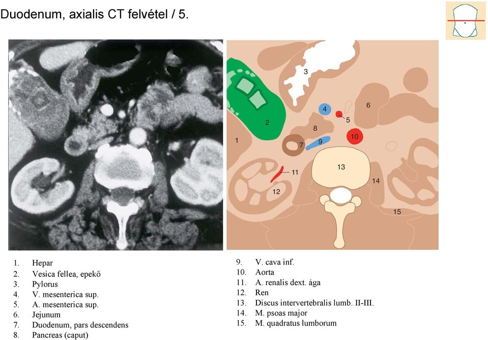 Duodenum, pars descendens 8. Pancreas (caput) 9. V. cava inf. 10. Aorta 11. A. renalis dext.