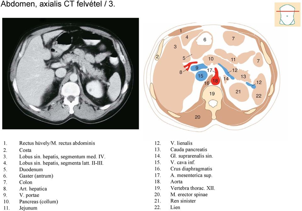 Pancreas (collum) 11. Jejunum 12. V. lienalis 13. Cauda pancreatis 14. Gl. suprarenalis sin. 15. V. cava inf. 16.