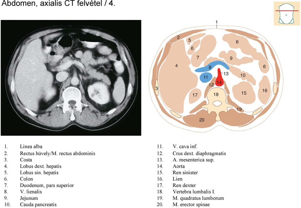 Jejunum 10. Cauda pancreatis 11. V. cava inf. 12. Crus dext. diaphragmatis 13. A. mesenterica sup. 14.