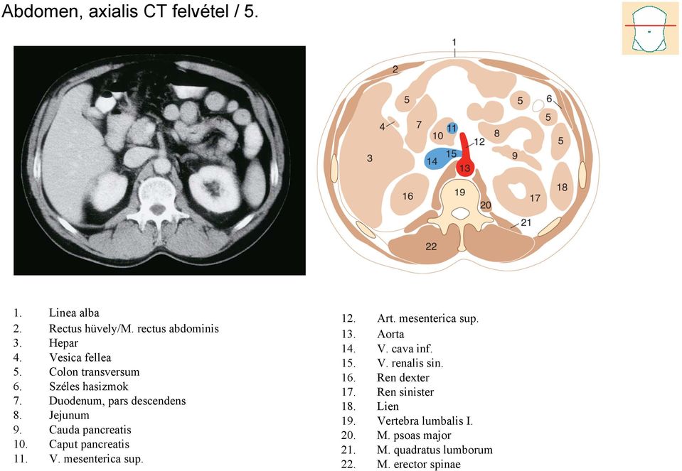 Caput pancreatis 11. V. mesenterica sup. 12. Art. mesenterica sup. 13. Aorta 14. V. cava inf. 15. V. renalis sin.