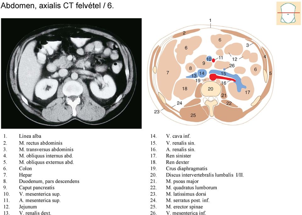 V. cava inf. 15. V. renalis sin. 16. A. renalis sin. 17. Ren sinister 18. Ren dexter 19. Crus diaphragmatis 20. Discus intervertebralis lumbalis I/II.