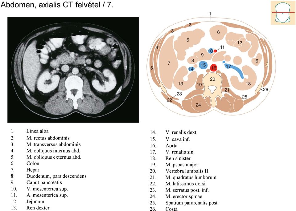 Ren dexter 14. V. renalis dext. 15. V. cava inf. 16. Aorta 17. V. renalis sin. 18. Ren sinister 19. M. psoas major 20. Vertebra lumbalis II.