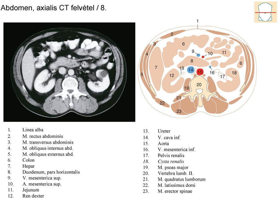 mesenterica sup. 11. Jejunum 12. Ren dexter 13. Ureter 14. V. cava inf. 15. Aorta 16. V. mesenterica inf. 17.