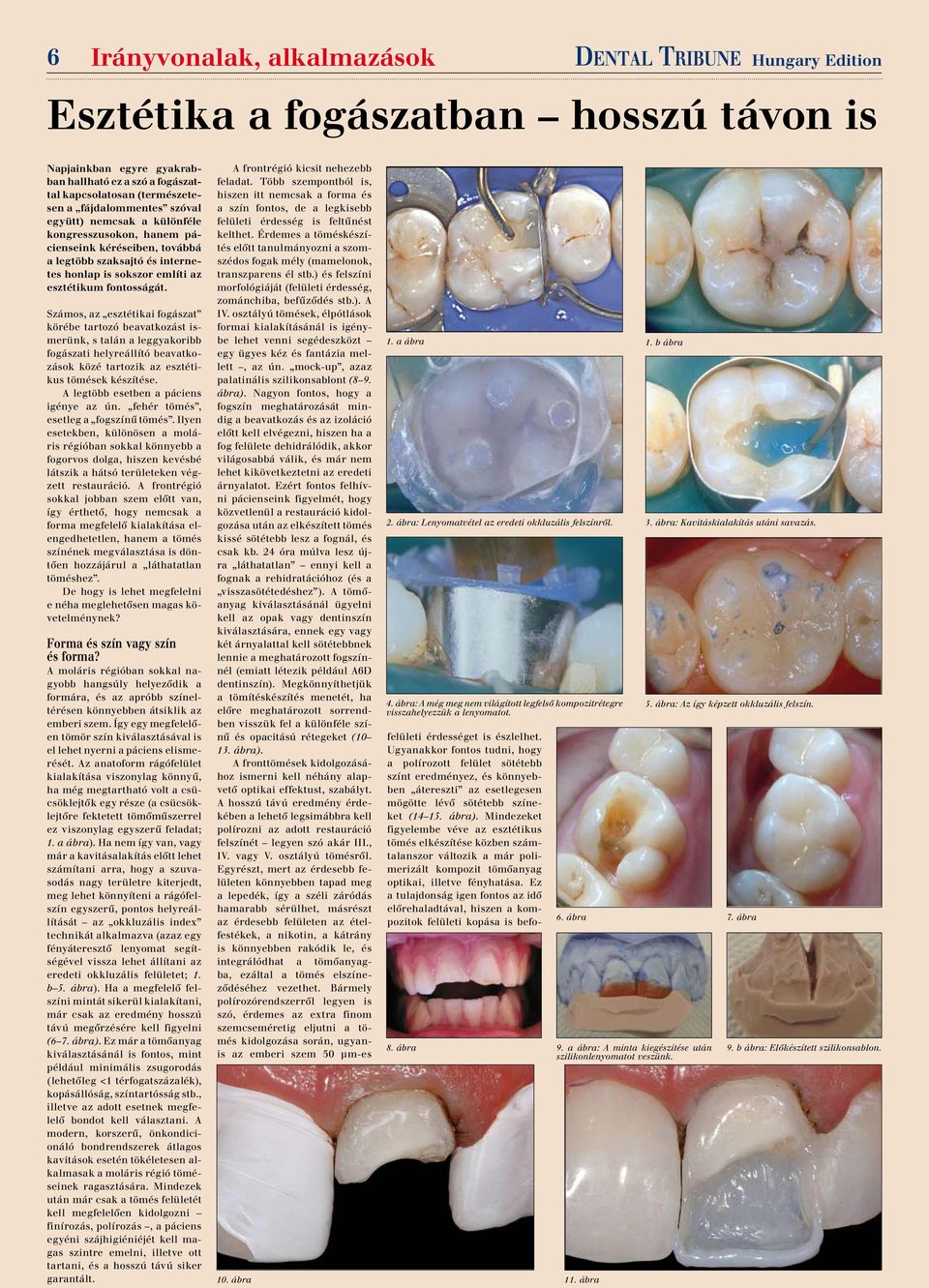 Számos, az esztétikai fogászat körébe tartozó beavatkozást ismerünk, s talán a leggyakoribb fogászati helyreállító beavatkozások közé tartozik az esztétikus tömések készítése.