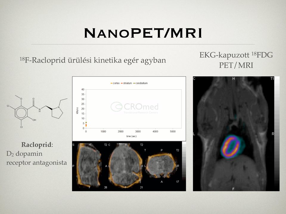 EKG-kapuzott 18 FDG PET/MRI