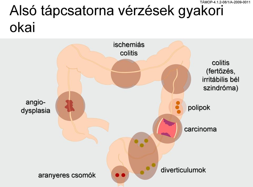 irritábilis bél szindróma) angiodysplasia