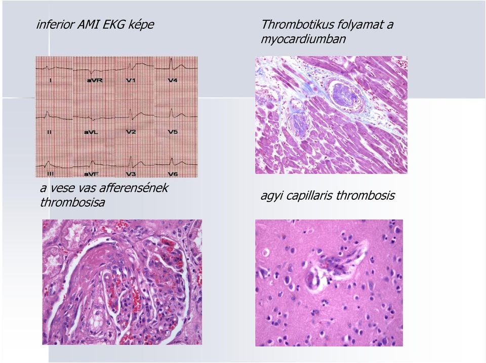 myocardiumban a vese vas