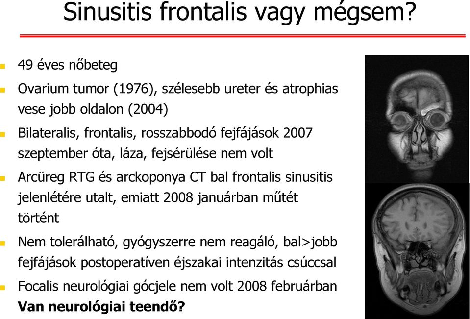 rosszabbodó fejfájások 2007 szeptember óta, láza, fejsérülése nem volt Arcüreg RTG és arckoponya CT bal frontalis sinusitis