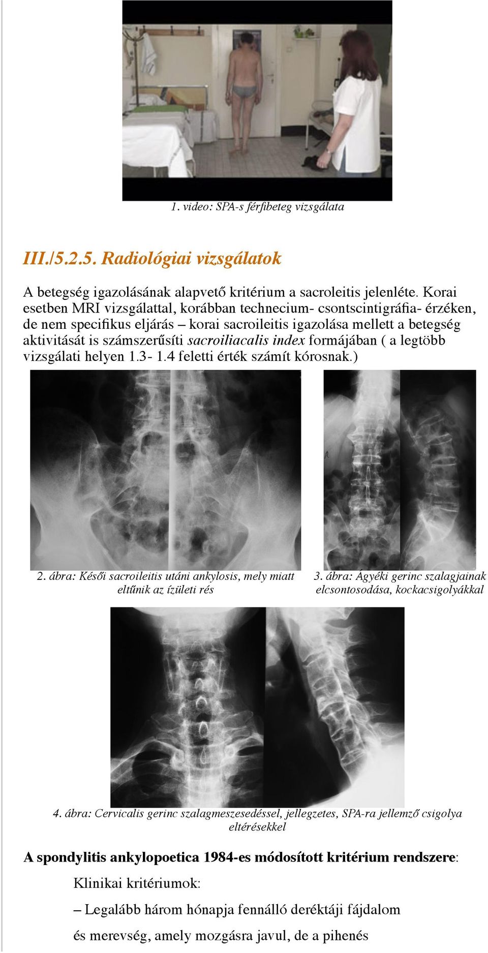 index formájában ( a legtöbb vizsgálati helyen 1.3-1.4 feletti érték számít kórosnak.) 2. ábra: Késői sacroileitis utáni ankylosis, mely miatt eltűnik az ízületi rés 3.