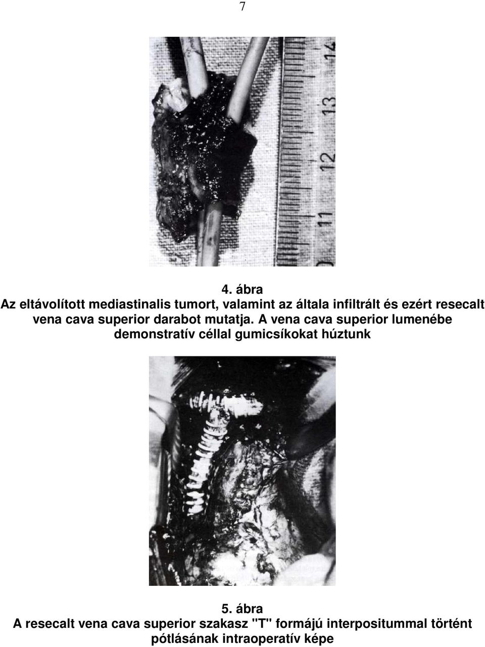 A vena cava superior lumenébe demonstratív céllal gumicsíkokat húztunk 5.