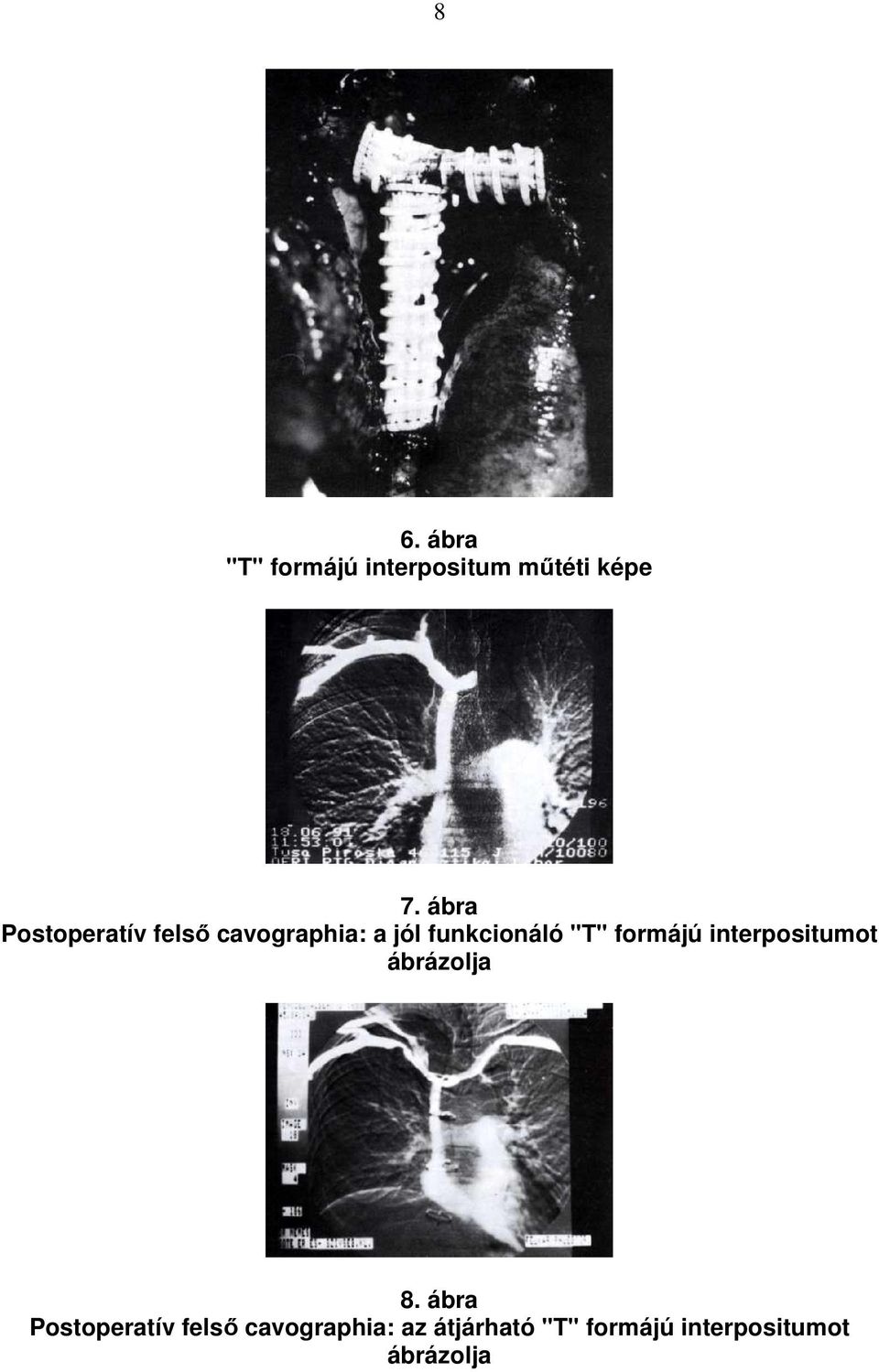 "T" formájú interpositumot ábrázolja 8.