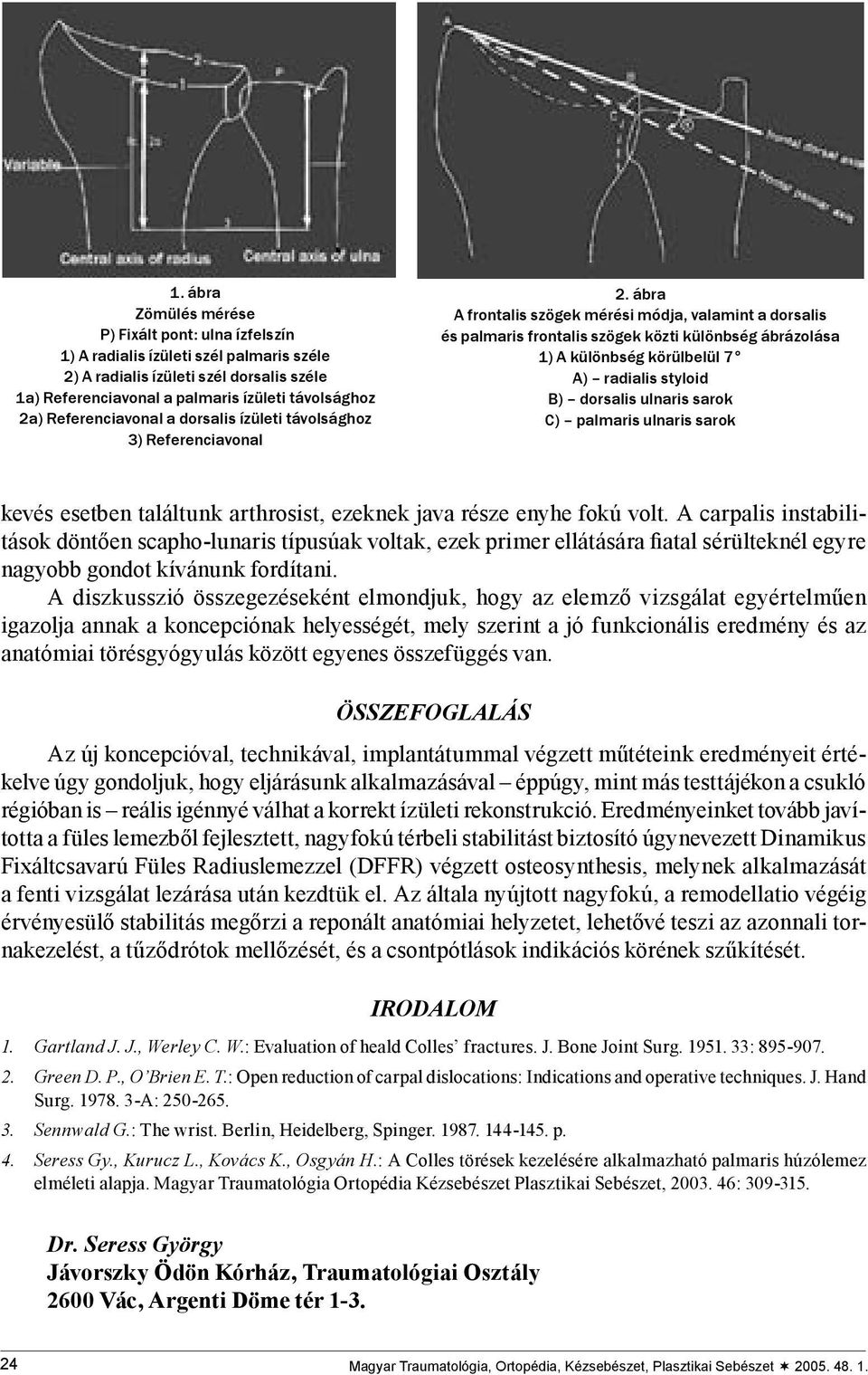 ábra A frontalis szögek mérési módja, valamint a dorsalis és palmaris frontalis szögek közti különbség ábrázolása 1) A különbség körülbelül 7 A) radialis styloid B) dorsalis ulnaris sarok C) palmaris