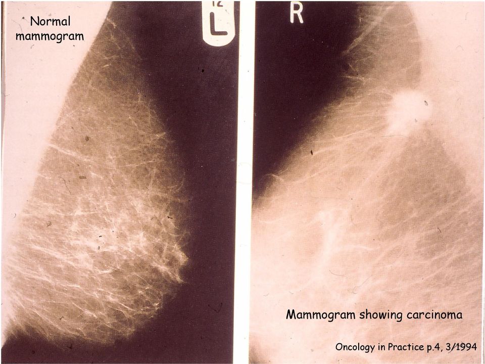 carcinoma ncology