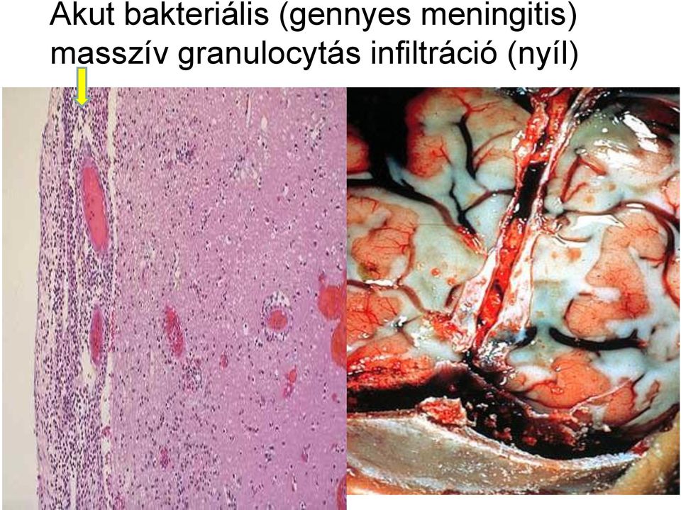 meningitis) masszív