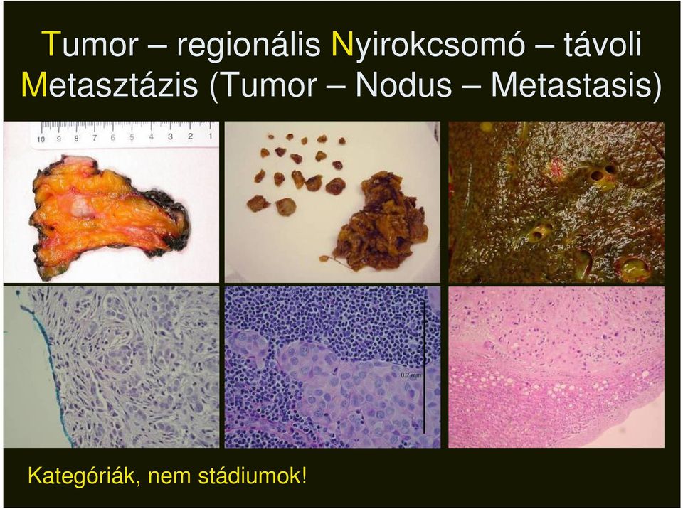 Metasztázis (Tumor Nodus