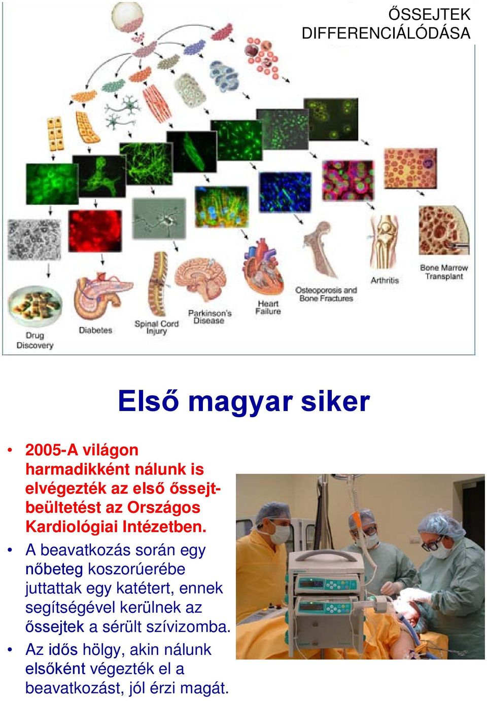A beavatkozás során egy nőbeteg koszorúerébe juttattak egy katétert, ennek segítségével