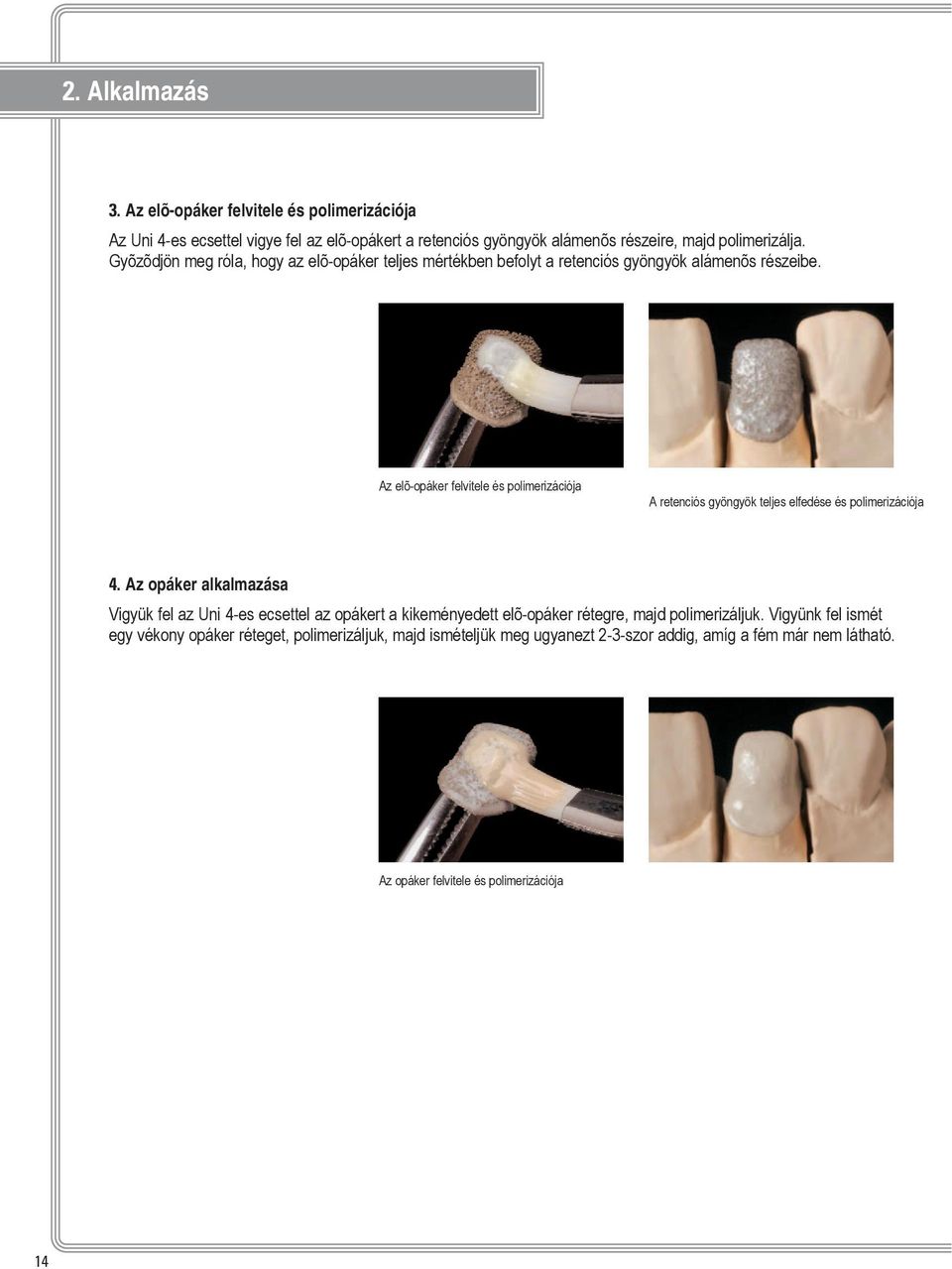 Az elõ-opáker felvitele és polimerizációja A retenciós gyöngyök teljes elfedése és polimerizációja 2. Anwendung 4.