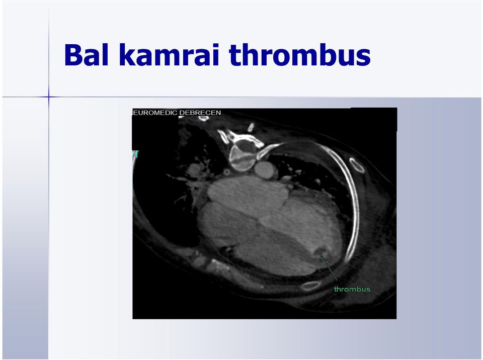 thrombus