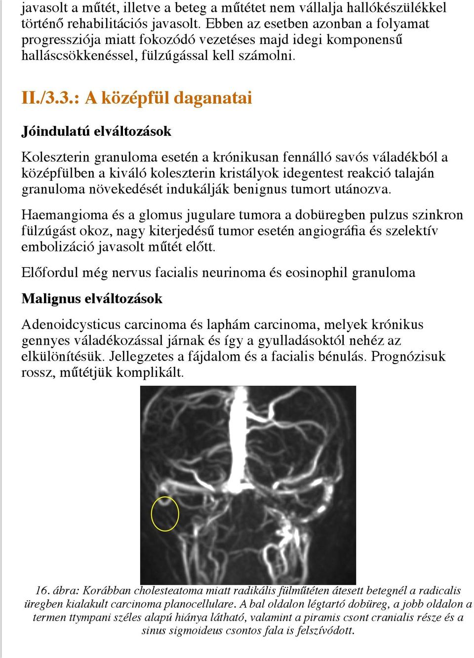 3.: A középfül daganatai Jóindulatú elváltozások Koleszterin granuloma esetén a krónikusan fennálló savós váladékból a középfülben a kiváló koleszterin kristályok idegentest reakció talaján granuloma