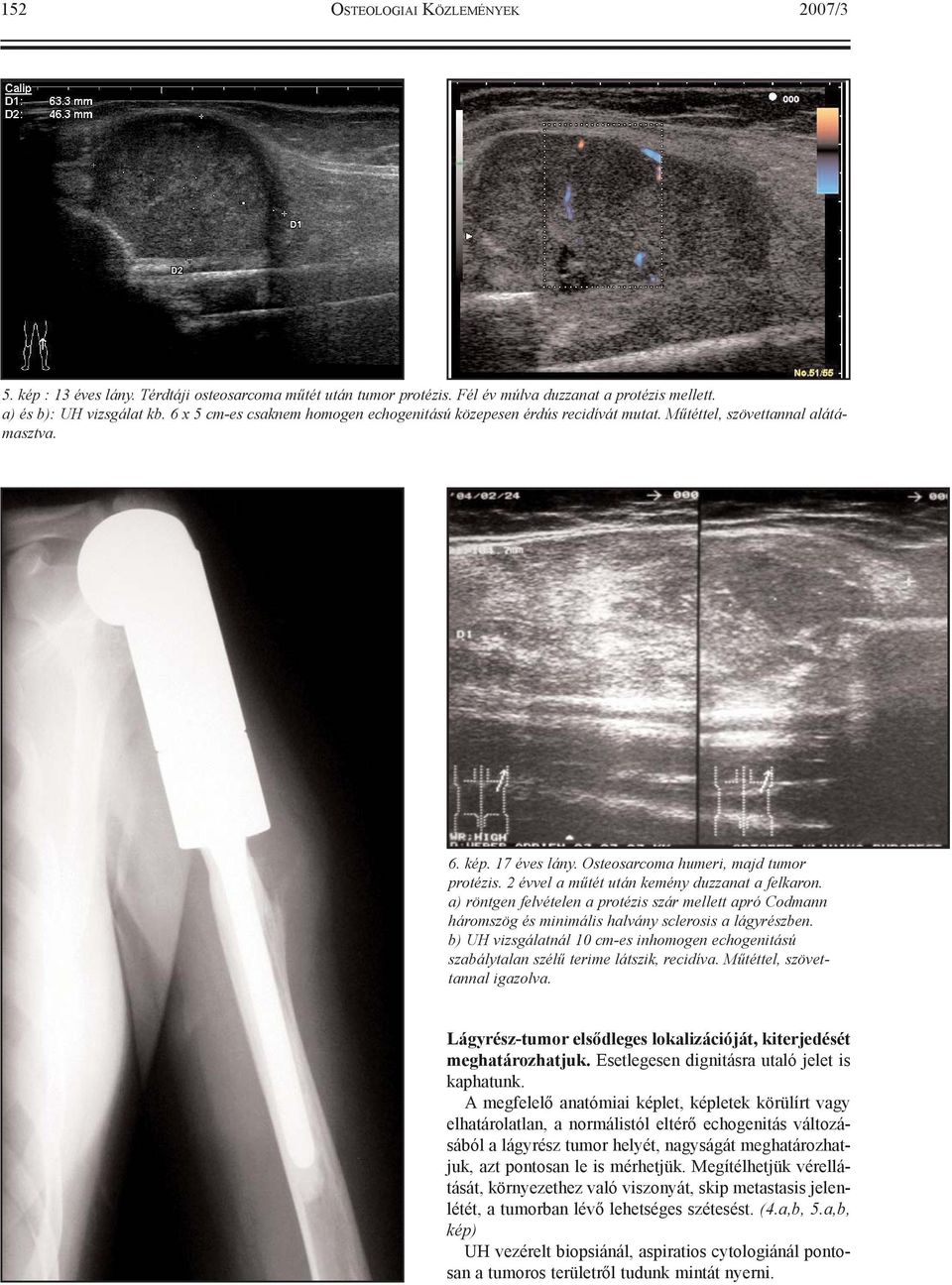 2 évvel a mûtét után kemény duzzanat a felkaron. a) röntgen felvételen a protézis szár mellett apró Codmann háromszög és minimális halvány sclerosis a lágyrészben.
