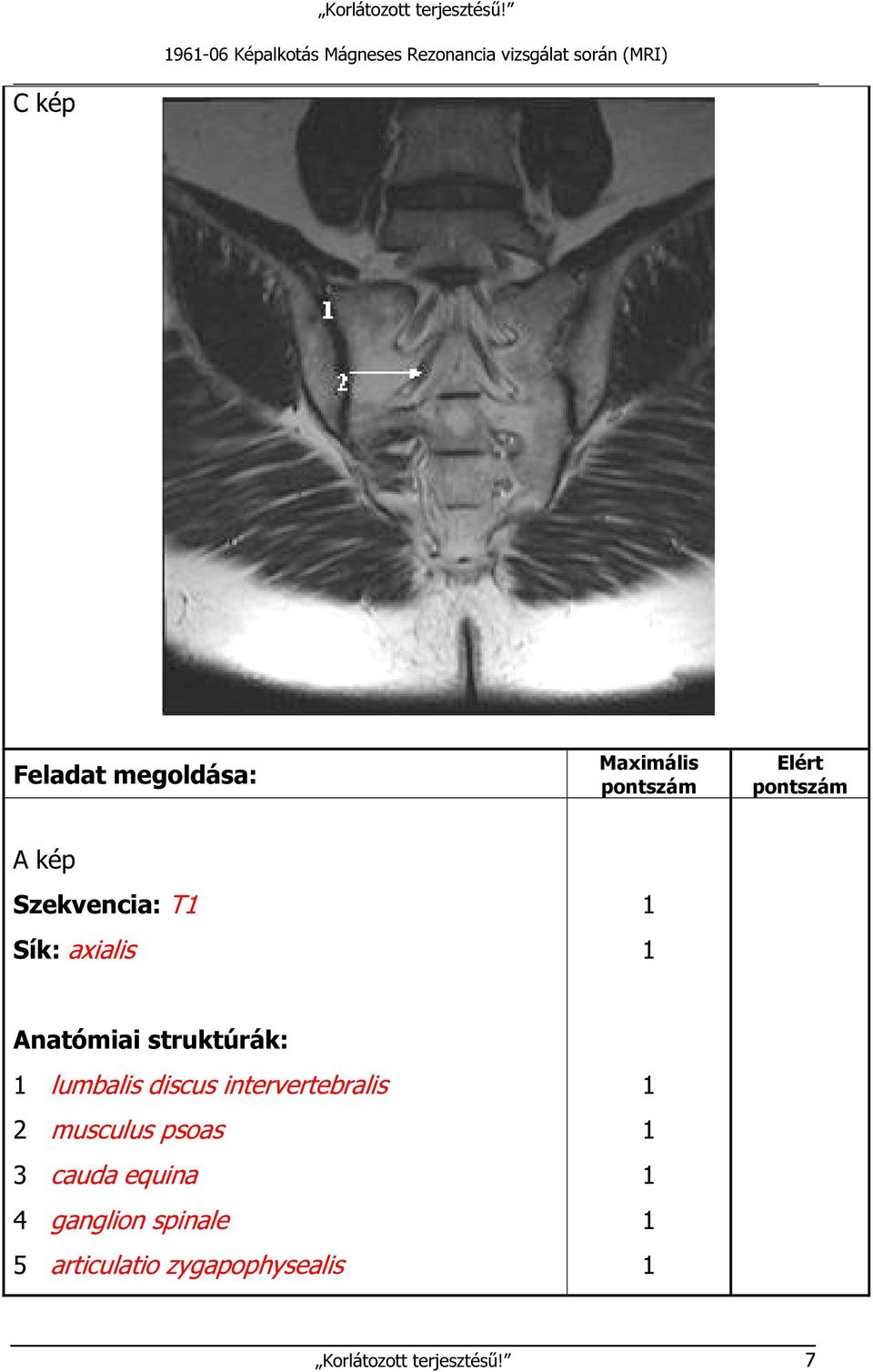 lumbalis discus intervertebralis 2 musculus psoas 3 cauda equina 4