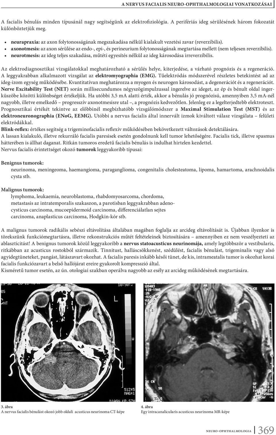 axonotmesis: az axon sérülése az endo-, epi-, és perineurium folytonosságának megtartása mellett (nem teljesen reverzíbilis).
