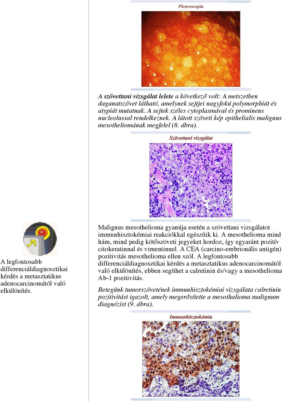 A legfontosabb differenciáldiagnosztikai kérdés a metasztatikus adenocarcinomától való elkülönítés.